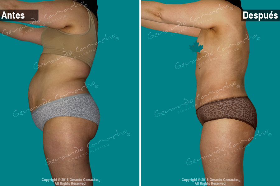 Cambio corporal con abdominoplastia realizado en Bogotá